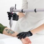 tatoeageverwijdering